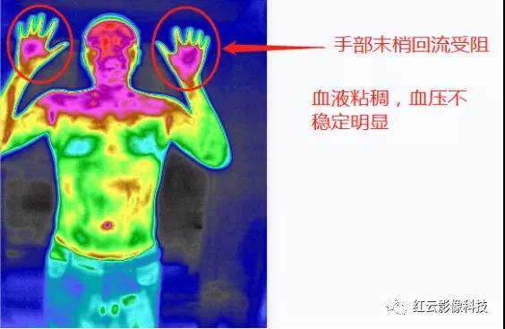图3，调理前的手部额面部热图.jpg